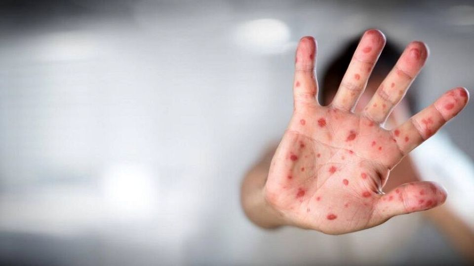 ویروس آبله میمونی روی سطوح ماندگار است؟